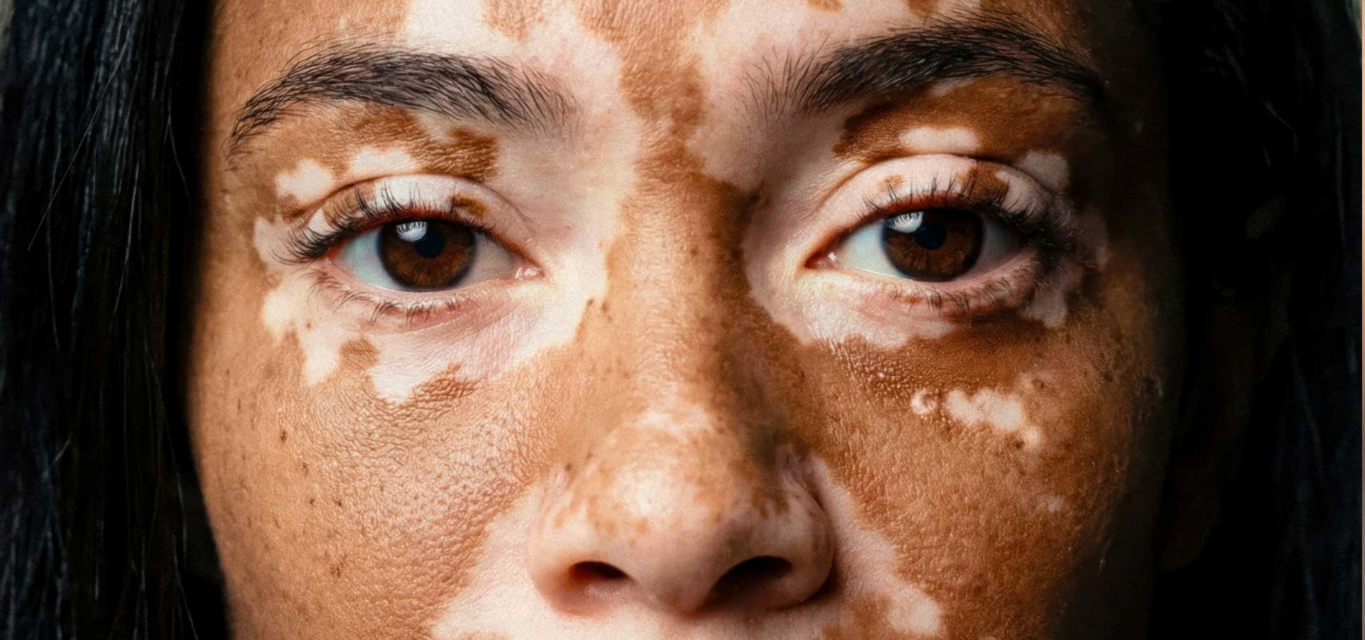 Paoderma